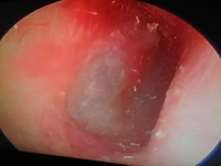 Akut Otitis Media Nasıl Oluşur? Akut Otitis Media Nasıl Oluşur?