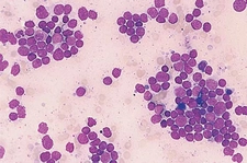 Akut Lenfoblastik Lösemi Belirtileri ve Tedavisi Akut Lenfoblastik Lösemi Belirtileri ve Tedavisi