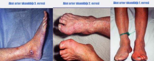 Akut Damarı Belirtileri ve Tedavisi